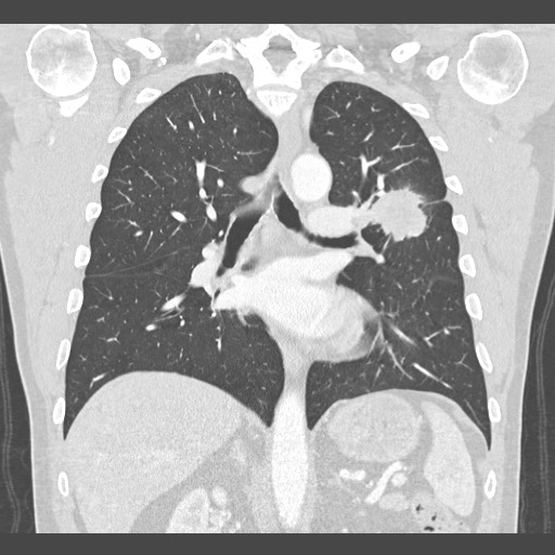 Adenocarcinoma of the lung (Radiopaedia 59871-67325 Coronal lung window 34).jpg