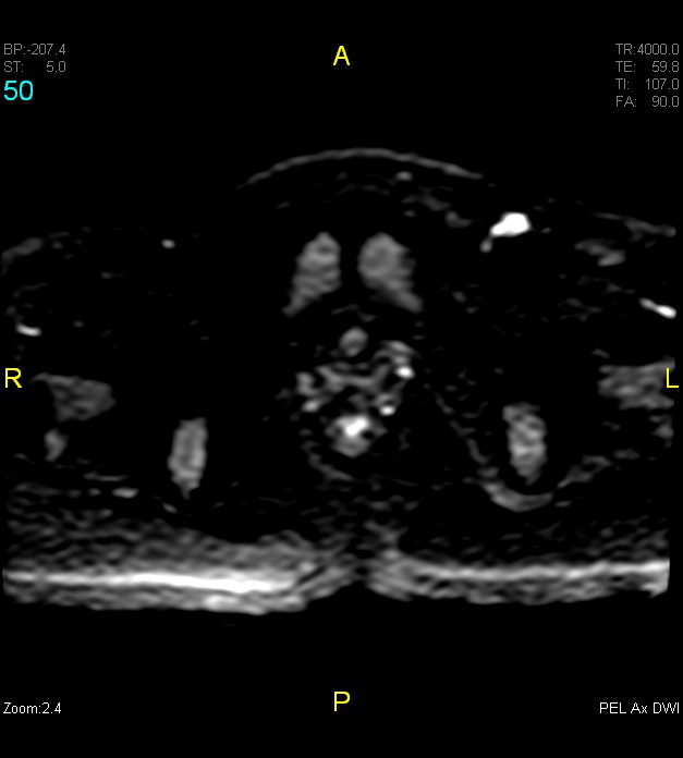 Adenomyosis (Radiopaedia 43504-46889 Axial DWI 50).jpg