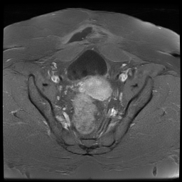 File:Adenomyosis within a didelphys uterus (Radiopaedia 70175-80215 Axial T1 C+ fat sat 26).jpg