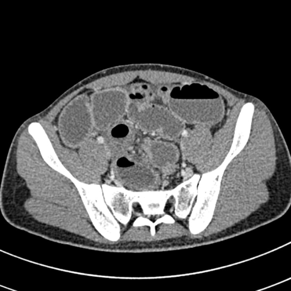 Adhesional small bowel obstruction (Radiopaedia 52107-57980 Axial C+ portal venous phase 99).jpg