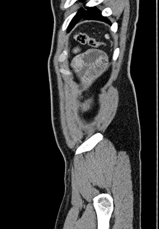 Adhesional small bowel obstruction (Radiopaedia 58900-66131 Sagittal C+ portal venous phase 229).jpg