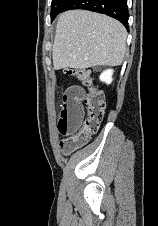 Adhesional small bowel obstruction (Radiopaedia 58900-66131 Sagittal C+ portal venous phase 49).jpg