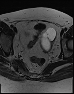File:Adnexal multilocular cyst (O-RADS US 3- O-RADS MRI 3) (Radiopaedia 87426-103754 Axial T2 14).jpg