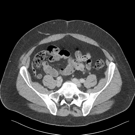 Adrenal cyst (Radiopaedia 45625-49777 Axial C+ portal venous phase 74).png