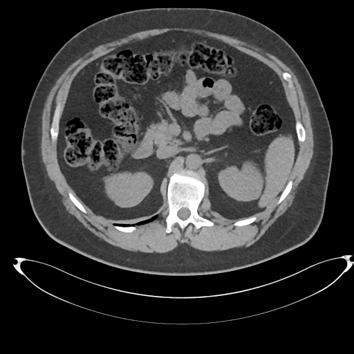 File:Adrenal cyst (Radiopaedia 45625-49778 Axial non-contrast 40).png