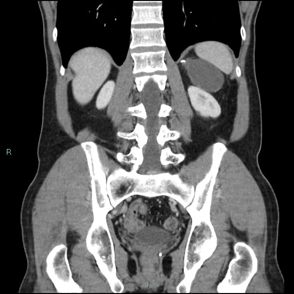 File:Adrenal cystic lymphangioma (Radiopaedia 83161-97534 Coronal C+ portal venous phase 54).jpg