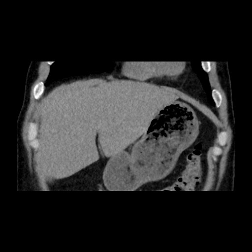 Adrenal gland trauma (Radiopaedia 81351-95079 Coronal non-contrast 22).jpg