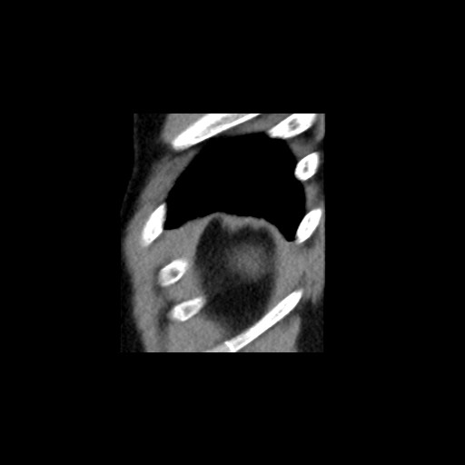 Adrenal gland trauma (Radiopaedia 81351-95079 Sagittal non-contrast 96).jpg