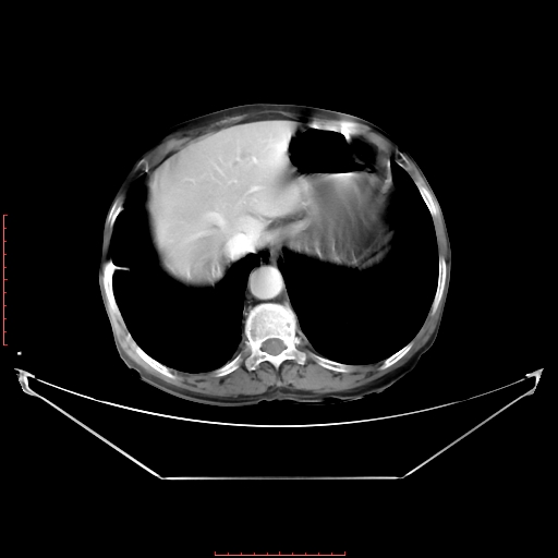 Adrenal hemangioma (Radiopaedia 68923-78668 Axial C+ portal venous phase 18).jpg