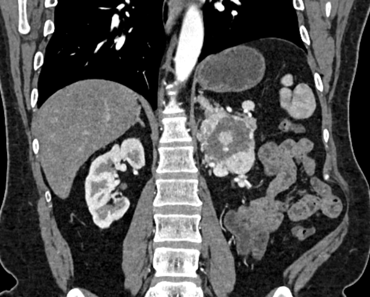 File:Adrenal metastases (Radiopaedia 73082-83791 Coronal C+ arterial phase 44).jpg