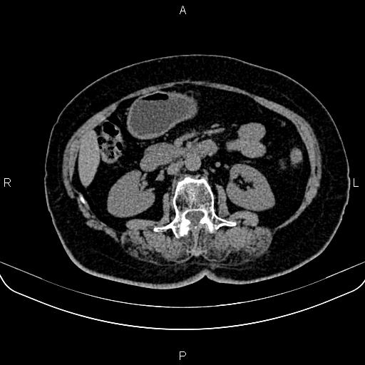 Adrenal myelolipoma (Radiopaedia 82742-96986 Axial non-contrast 71).jpg