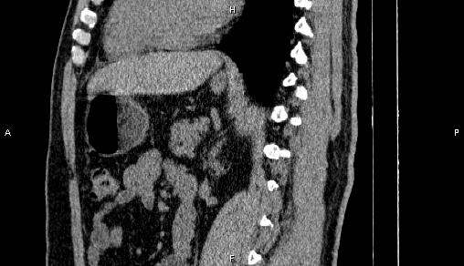 Adrenal myelolipoma (Radiopaedia 84321-99619 Sagittal non-contrast 64).jpg