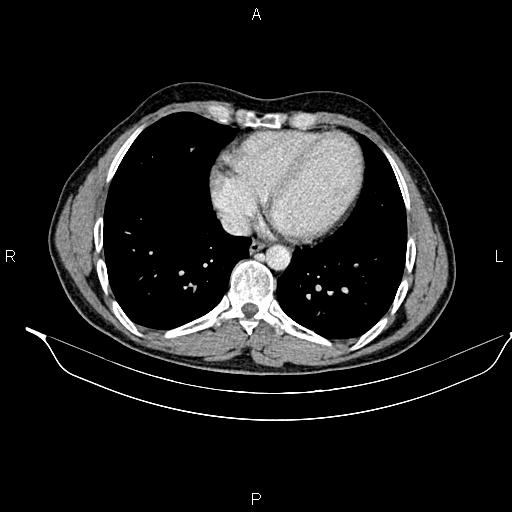 Adrenal myelolipoma (Radiopaedia 87794-104246 Axial renal cortical phase 6).jpg