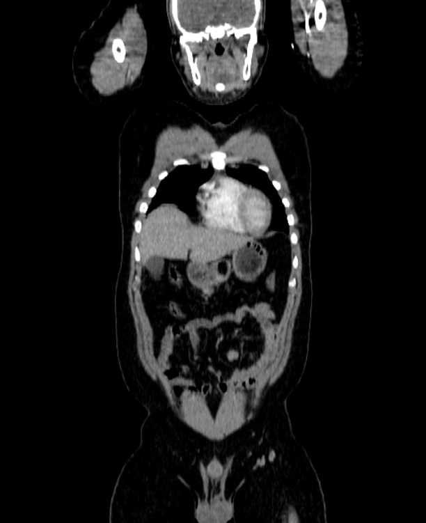 Adrenocortical carcinoma (Radiopaedia 80134-93438 Coronal C+ portal venous phase 43).jpg