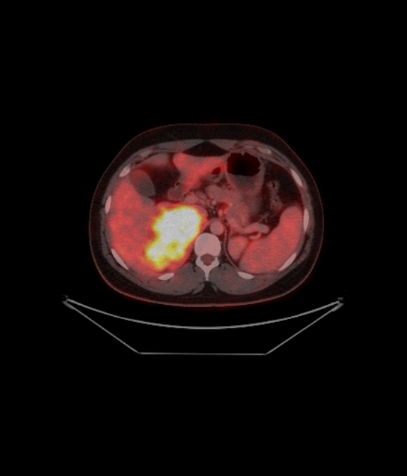 Adrenocortical carcinoma (Radiopaedia 80134-93440 ِAxial 158).jpg