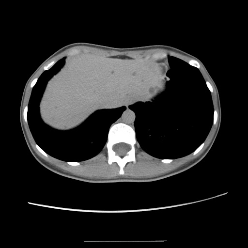 File:Adult polycystic kidney disease (Radiopaedia 48845-53876 Axial renal excretory phase 19).jpg