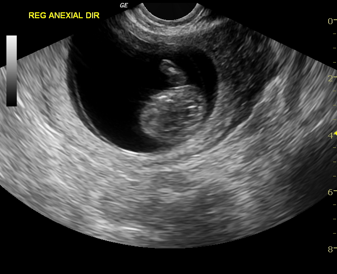 File:Advanced ectopic pregnancy (Radiopaedia 12862-12983 E 1).jpg