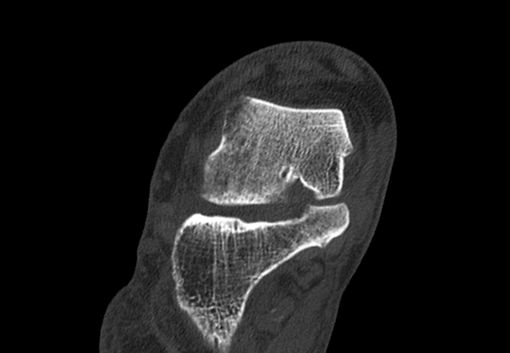 Advanced osteomyelitis due to open metatarsal fracture (Radiopaedia 83891-99095 Axial bone window 9).jpg