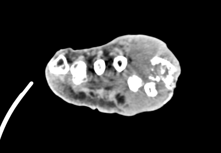 Advanced osteomyelitis due to open metatarsal fracture (Radiopaedia 83891-99095 Axial non-contrast 41).jpg
