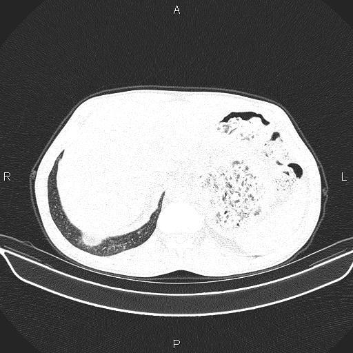 Air bronchogram in pneumonia (Radiopaedia 85719-101512 Axial lung window 66).jpg