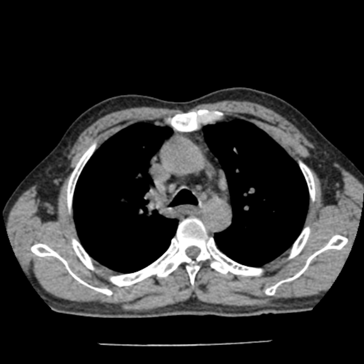 Airway foreign body in adult (Radiopaedia 85907-101779 Axial liver window 49).jpg