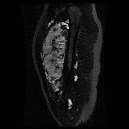 Alveolar soft part sarcoma (Radiopaedia 64501-73678 D 92).jpg