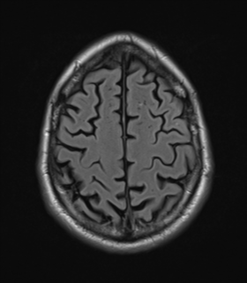 File:Alzheimer's disease- with Gerstmann syndrome and dressing apraxia (Radiopaedia 54882-61150 Axial FLAIR 23).png