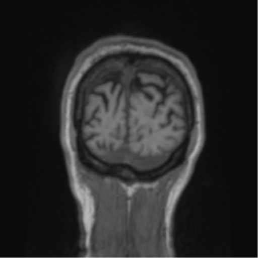 File:Alzheimer's disease- with apraxia (Radiopaedia 54763-61011 Coronal T1 14).png