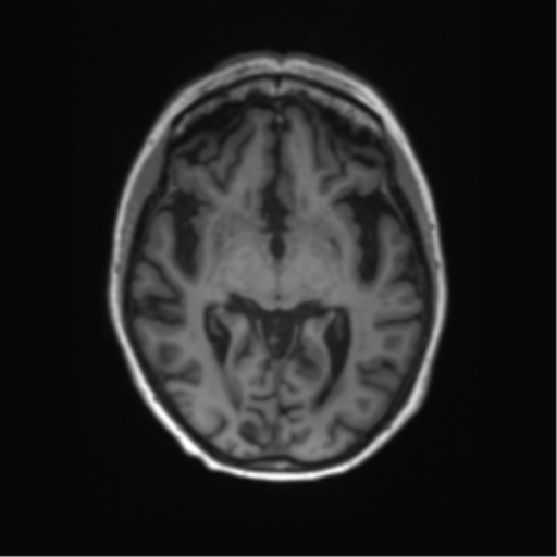 File:Alzheimer's disease (Radiopaedia 42658-45802 Axial T1 87).png