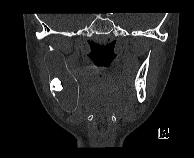 File:Ameloblastoma (Radiopaedia 26645-26793 bone window 16).jpg