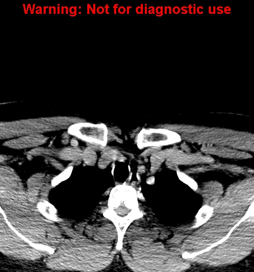 File:Ameloblastoma (Radiopaedia 33126-34164 B 47).jpg