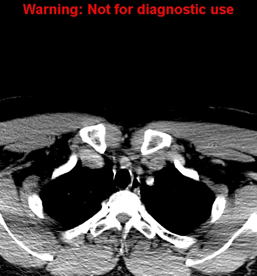 File:Ameloblastoma (Radiopaedia 33126-34164 B 50).jpg
