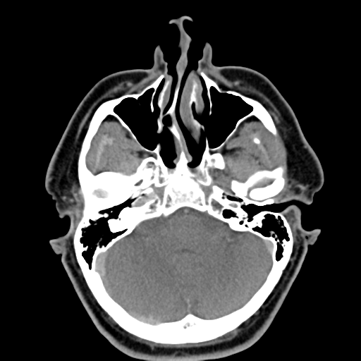 File:Ameloblastoma (Radiopaedia 38520-40623 Axial non-contrast 13).png