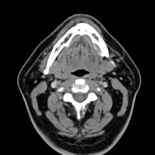 Ameloblastoma (Radiopaedia 38520-40623 Axial non-contrast 35).png