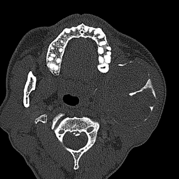 Ameloblastoma (Radiopaedia 51921-57766 Axial bone window 97).jpg