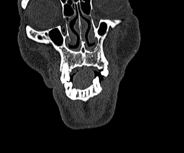 Ameloblastoma (Radiopaedia 51921-57766 Coronal bone window 30).jpg