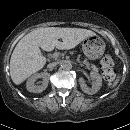File:Amiodarone-induced pulmonary fibrosis (Radiopaedia 82355-96460 Axial non-contrast 63).jpg