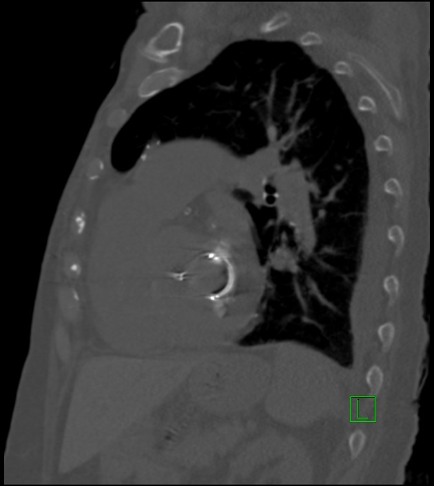 Amiodarone deposition in the liver (Radiopaedia 77587-89780 Sagittal bone window 37).jpg