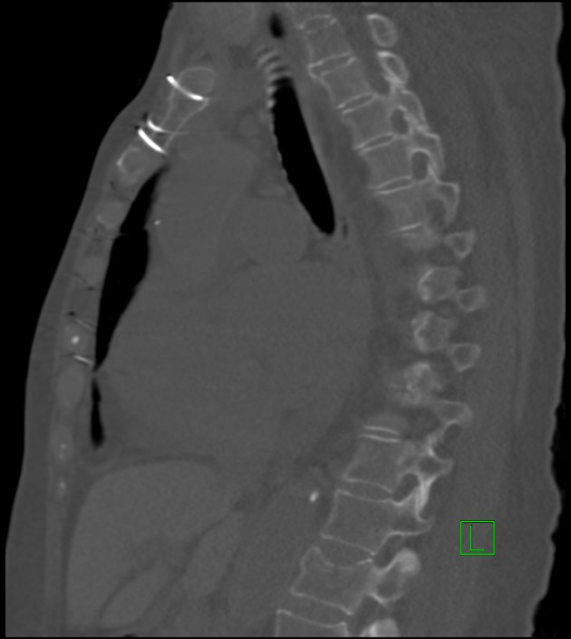 Amiodarone deposition in the liver (Radiopaedia 77587-89780 Sagittal bone window 50).jpg