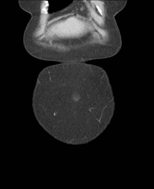 Ampullary adenocarcinoma (Radiopaedia 34013-35237 E 7).png