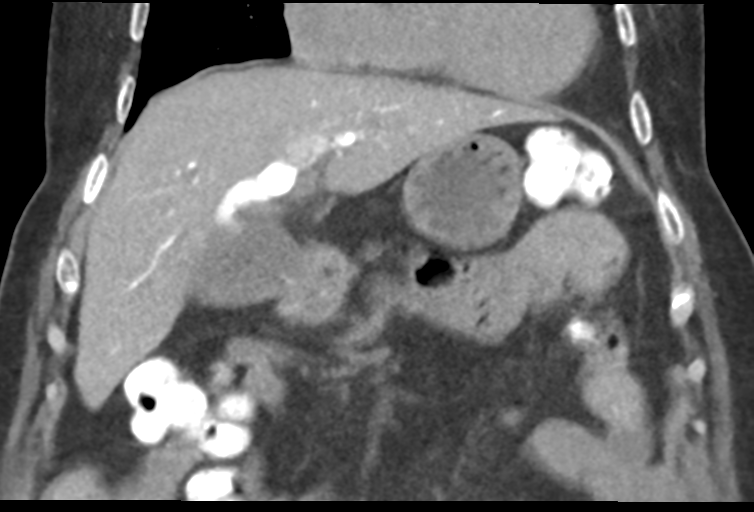 Ampullary adenocarcinoma (Radiopaedia 34013-35241 Coronal 17).png