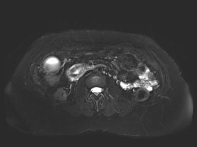 Ampullary adenocarcinoma (Radiopaedia 54765-61014 Axial T2 space-FS 48).jpg