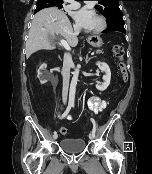 Ampullary adenocarcinoma (Radiopaedia 59373-66734 D 52).jpg