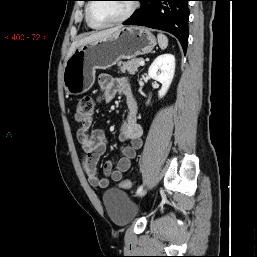Ampullary carcinoma (Radiopaedia 56396-63056 D 71).jpg