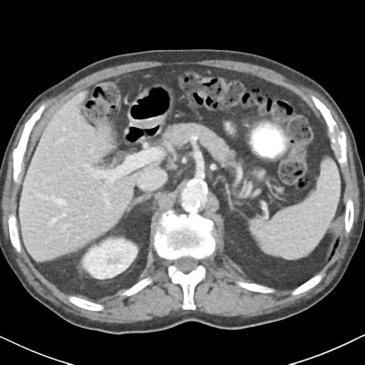 File:Amyand hernia (Radiopaedia 39300-41547 A 17).png