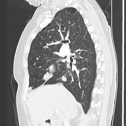 Amyloidosis - bronchial and diffuse nodular pulmonary involvement (Radiopaedia 60156-67745 Sagittal lung window 34).jpg