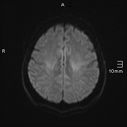 File:Amyotrophic lateral sclerosis (Radiopaedia 70821-81017 Axial DWI 11).jpg