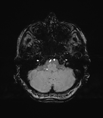 Anaplastic astrocytoma (Radiopaedia 86943-103160 Axial SWI 20).png