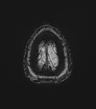 Anaplastic astrocytoma - thalamic glioma (Radiopaedia 59709-67115 G 84).png