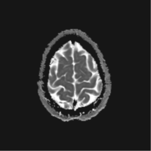 File:Anaplastic astrocytoma IDH mutant (Radiopaedia 50046-55341 Axial ADC 25).png